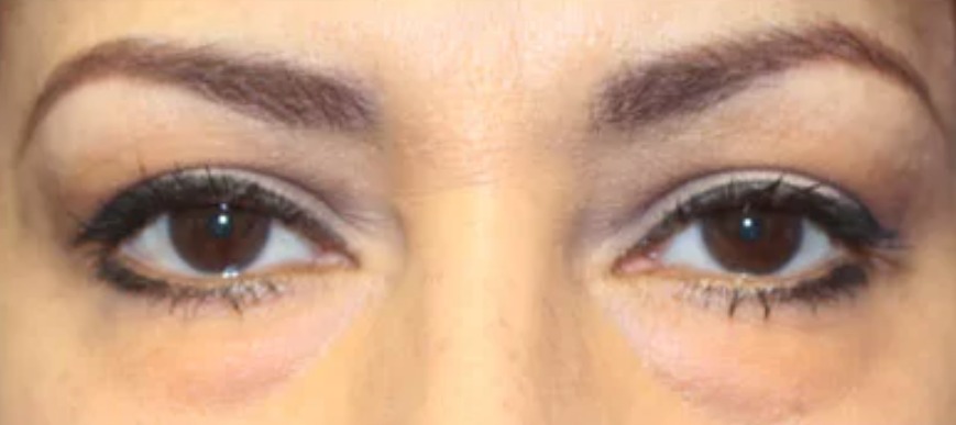 Before Eyes - Front View